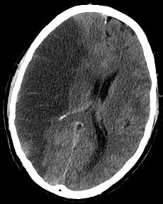 230px-INFARCT.jpg 230px-INFARCT.jpg