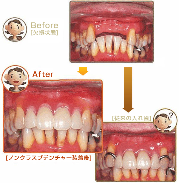 バルプラスト