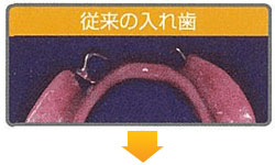 バルプラスト
