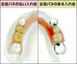 ノンクラスプデンチャーとは
