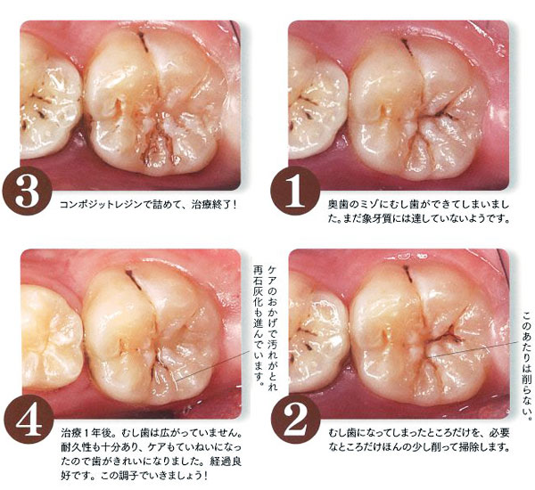 保険治療