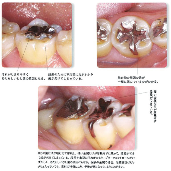 保険治療