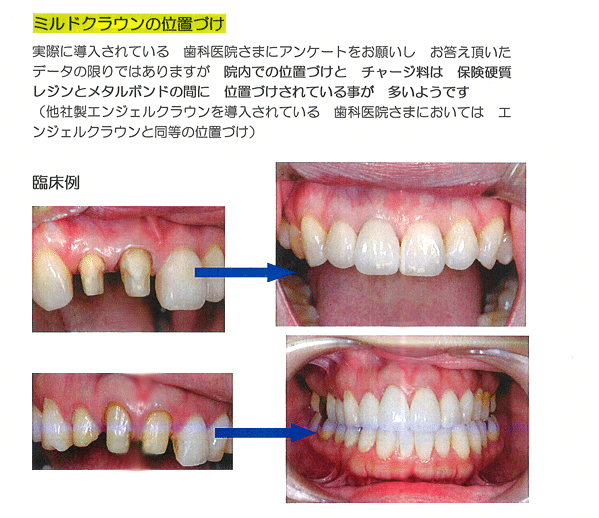 ミルドクラウン